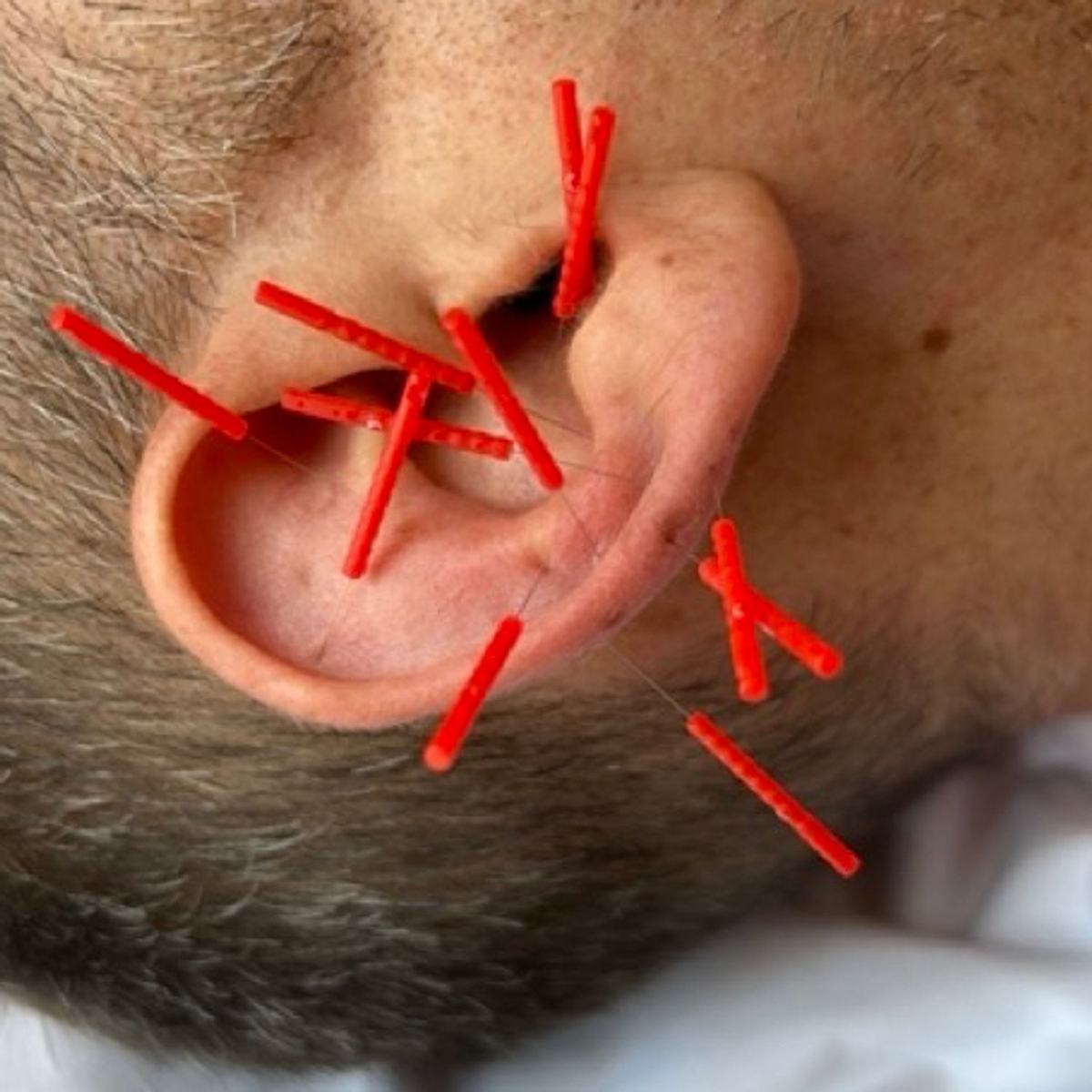 Déprimé? En souffrance? Et si on vous piquait les oreilles?