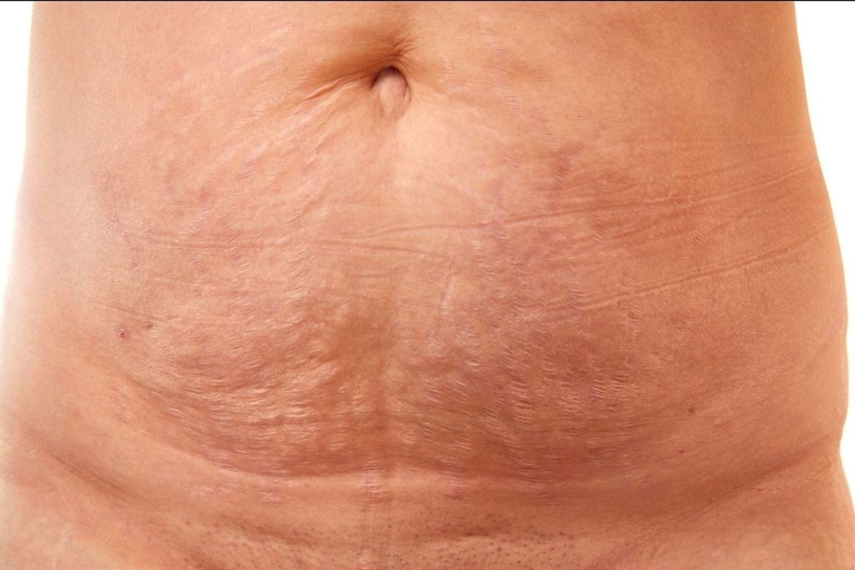 Traitement des vergetures à Rouen : Microneedling & SQT, solutions efficaces chez Royal Laila Beauty