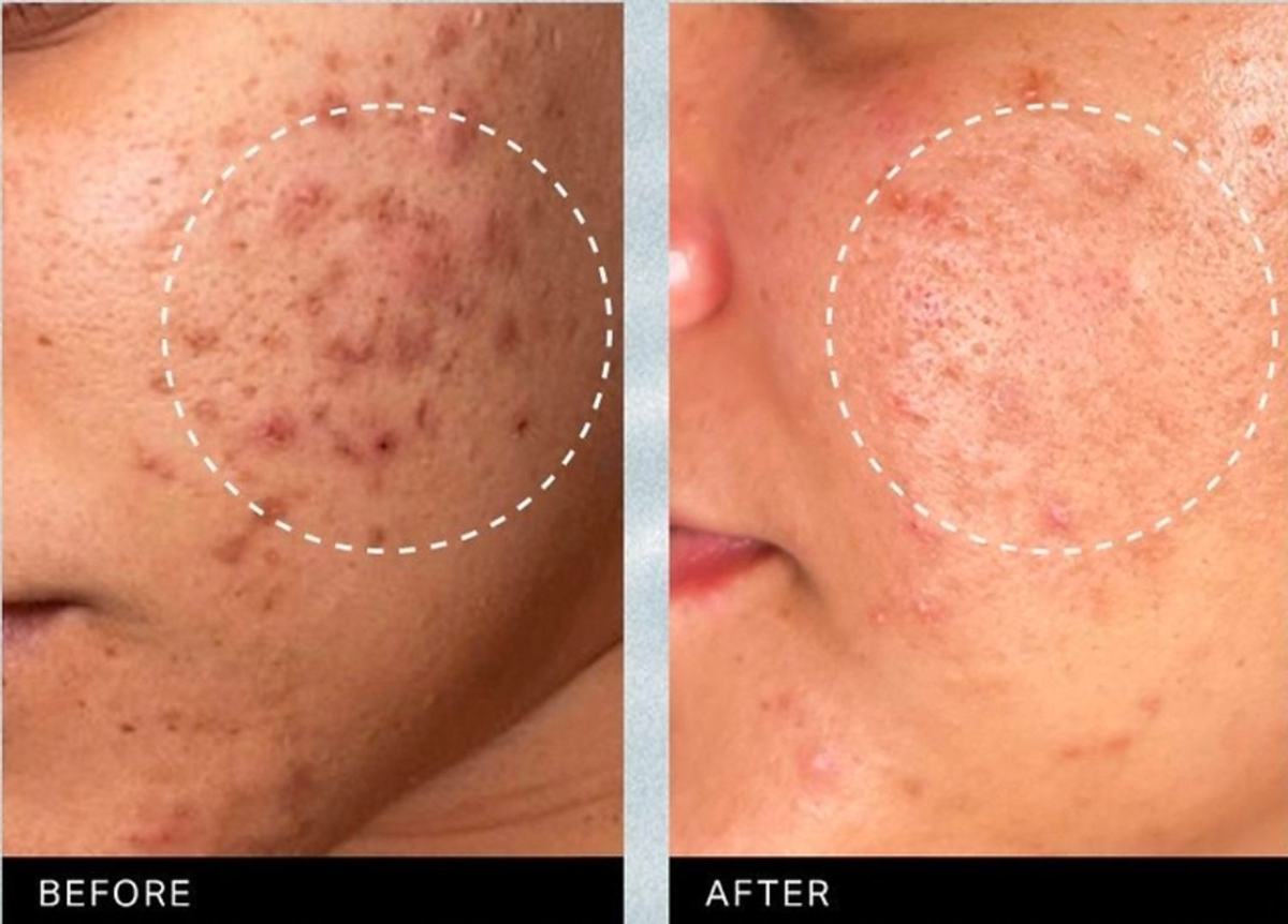 Traitement des boutons du visage par Hydrafacial à Rouen