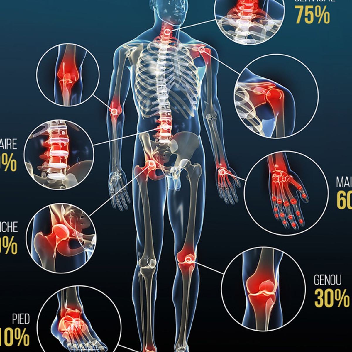 soulagement de l arthrose à Pamiers