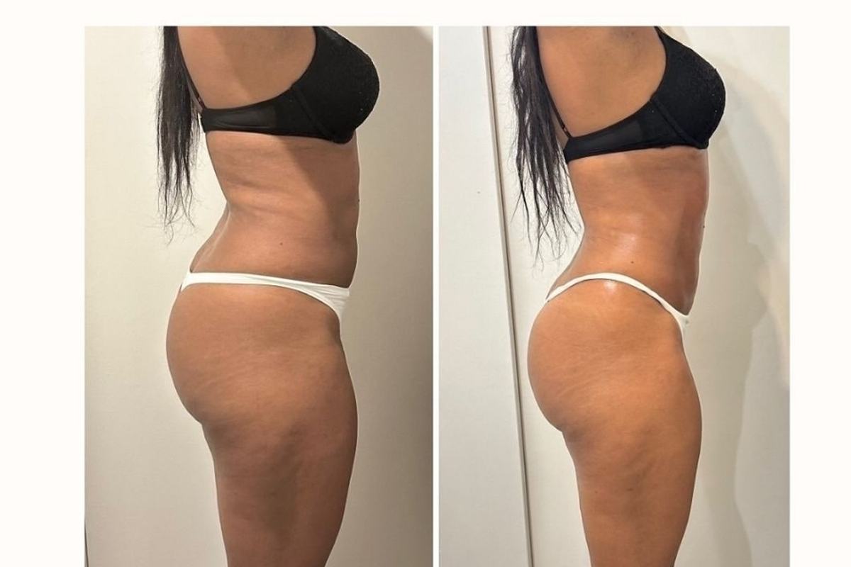 Lipocavitation à Bois-Guillaume près de Rouen : affinez votre silhouette sans chirurgie