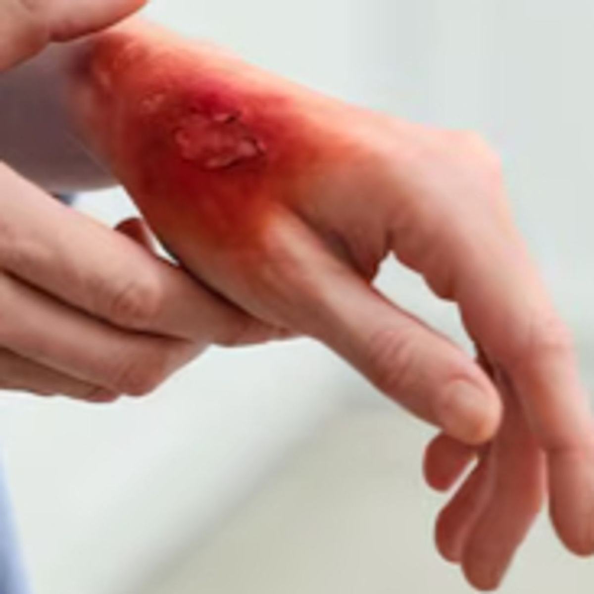 Brûlure calmée, douleur apaisée : l'action coupe-feu du Reiki