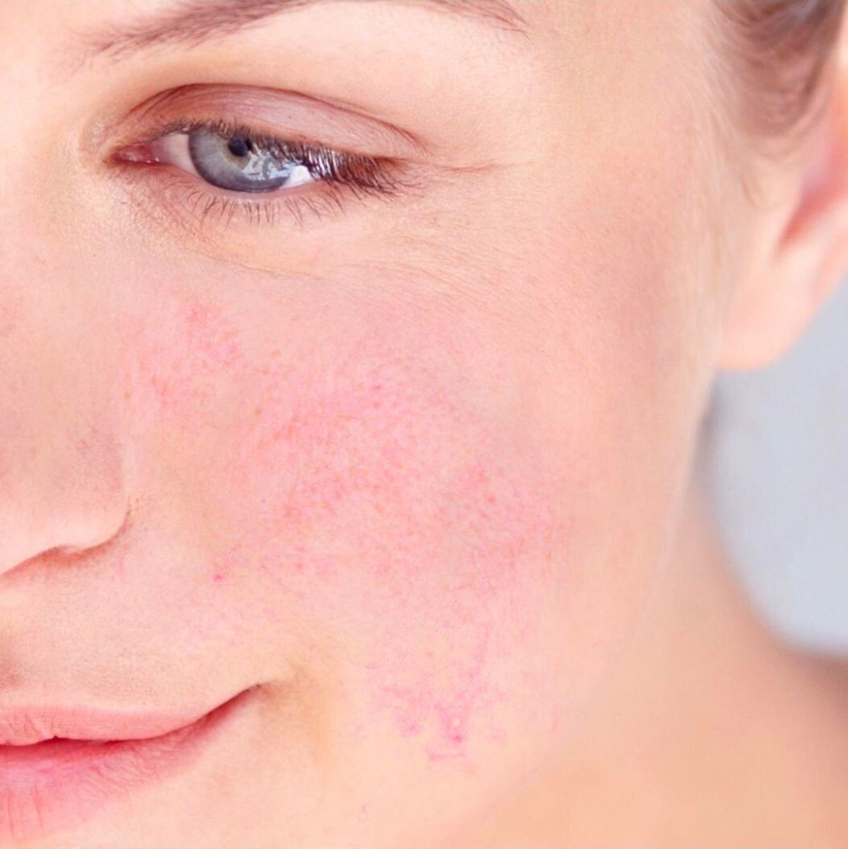 Peau sensible et sèche à Rouen : solutions professionnelles avec le Soin Royal et le peeling SQT nourrissant