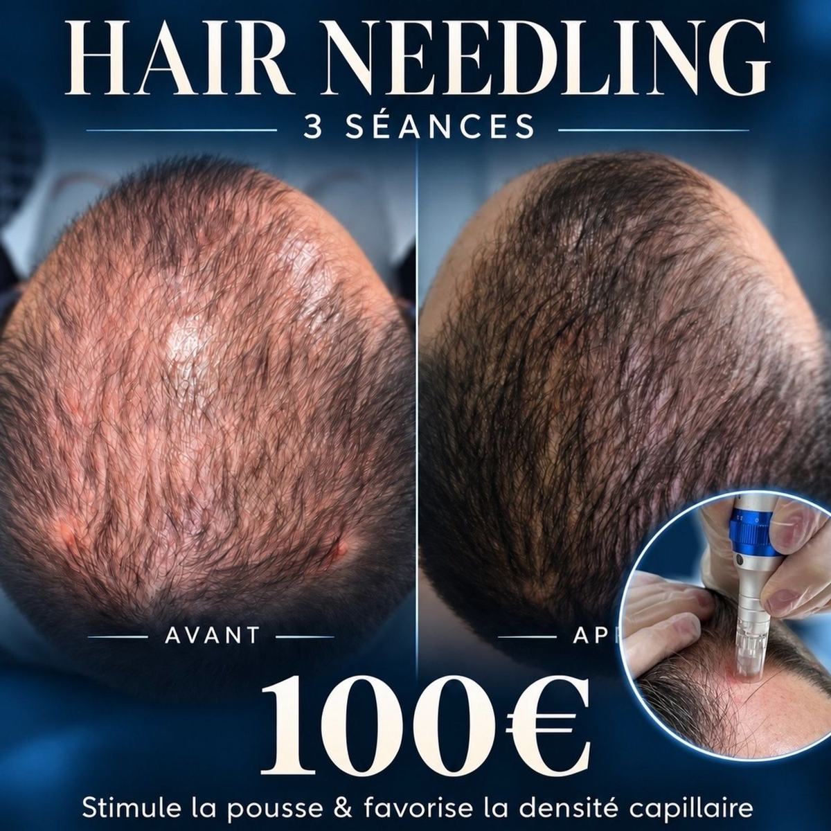 Offre découverte Hair Needling