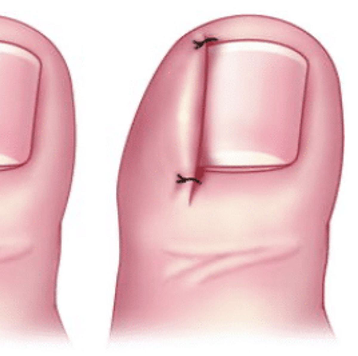 🚫 Ongles incarnés : causes, prévention et conseils pour les soulager