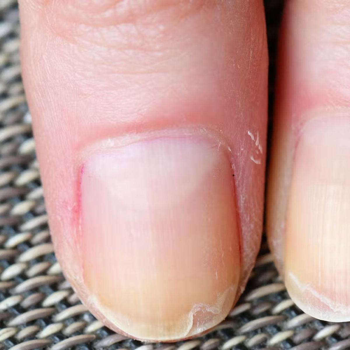 💅 Pourquoi vos ongles se dédoublent-ils ? Comprendre et prévenir ce problème courant