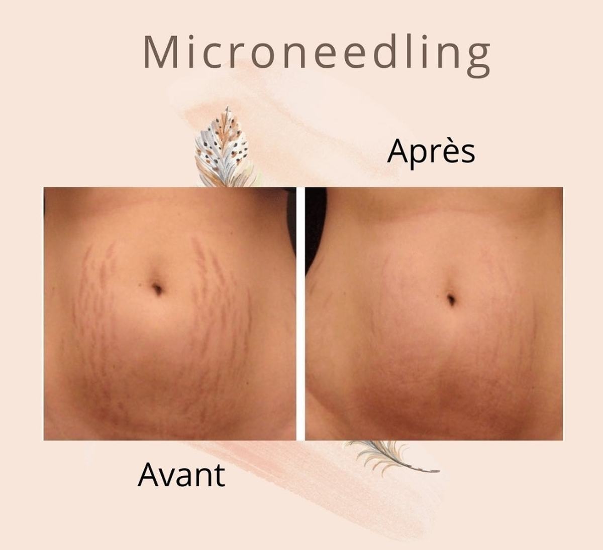 Cure Microneedling Vergetures du Ventre – 4 Séances