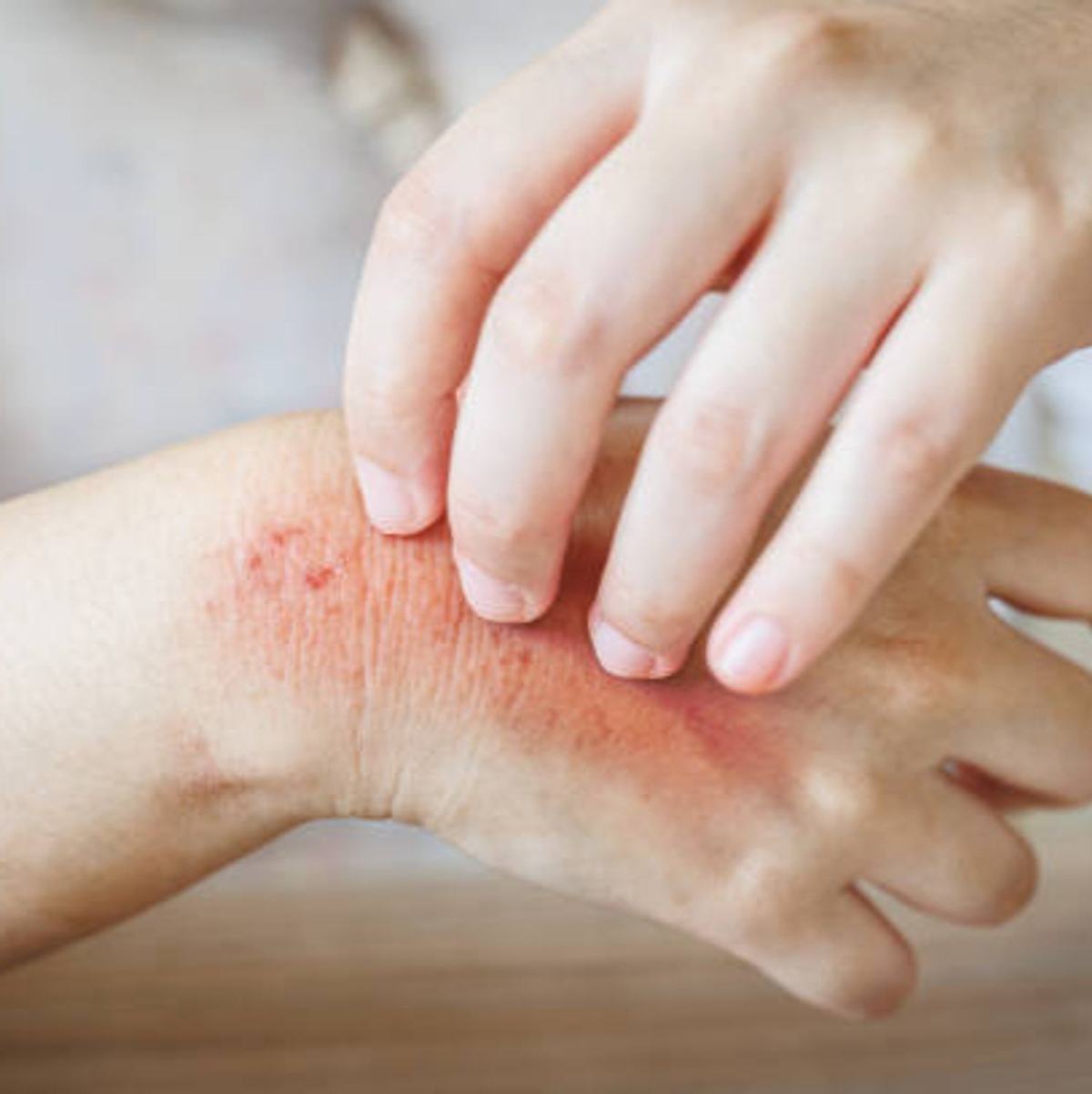 Allergies aux produits : comment les éviter ?