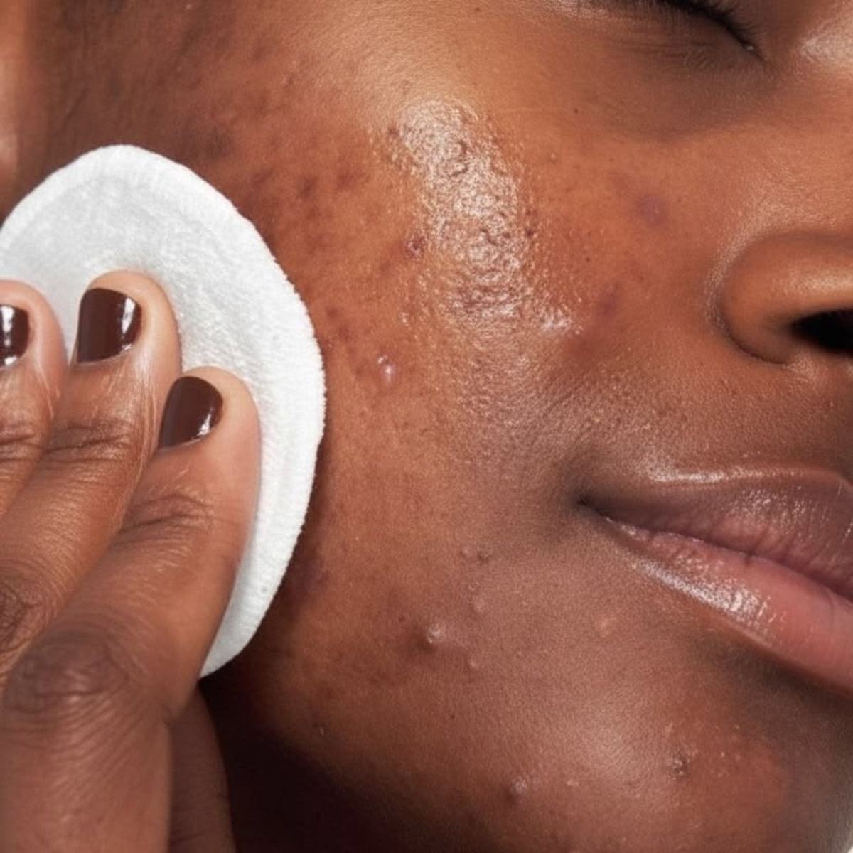 Le soin Acné Solution : une réponse ciblée contre les imperfections.