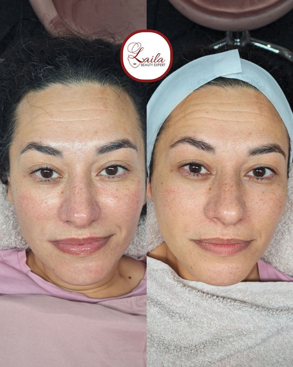 Hydrafacial à Rouen : le soin visage nouvelle génération pour une peau éclatante